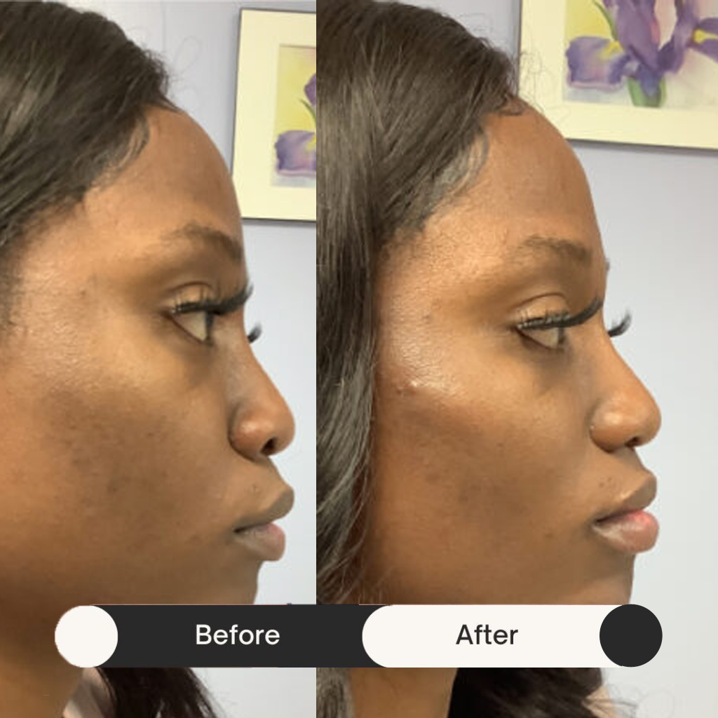dermal fillers before & after first treatment