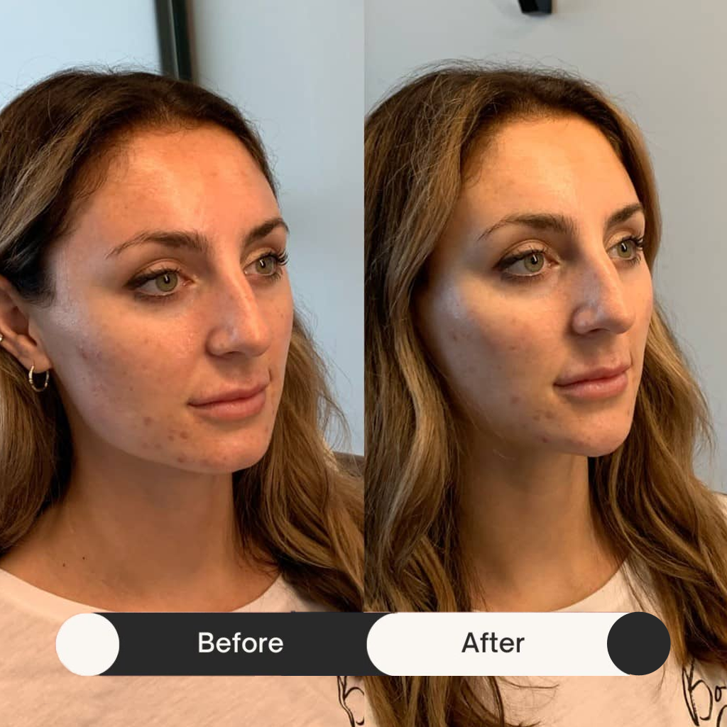 dermal fillers before & after second treatment