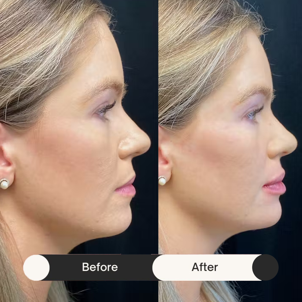 dermal fillers before & after third treatment