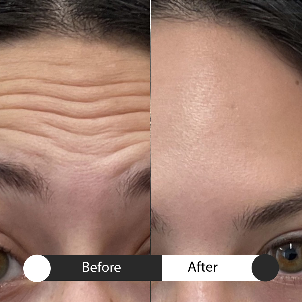 neurotoxins before & after first treatment