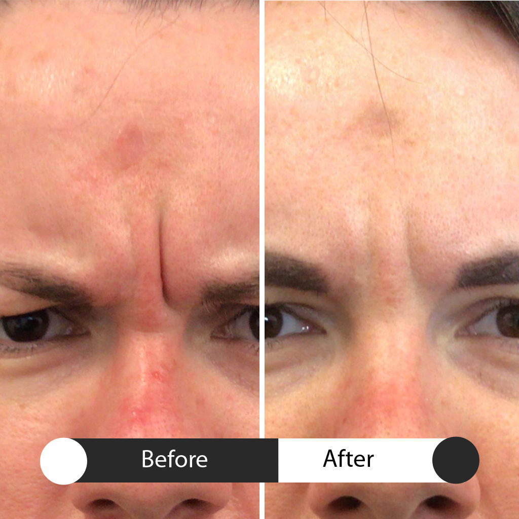 neurotoxins before & after second treatment