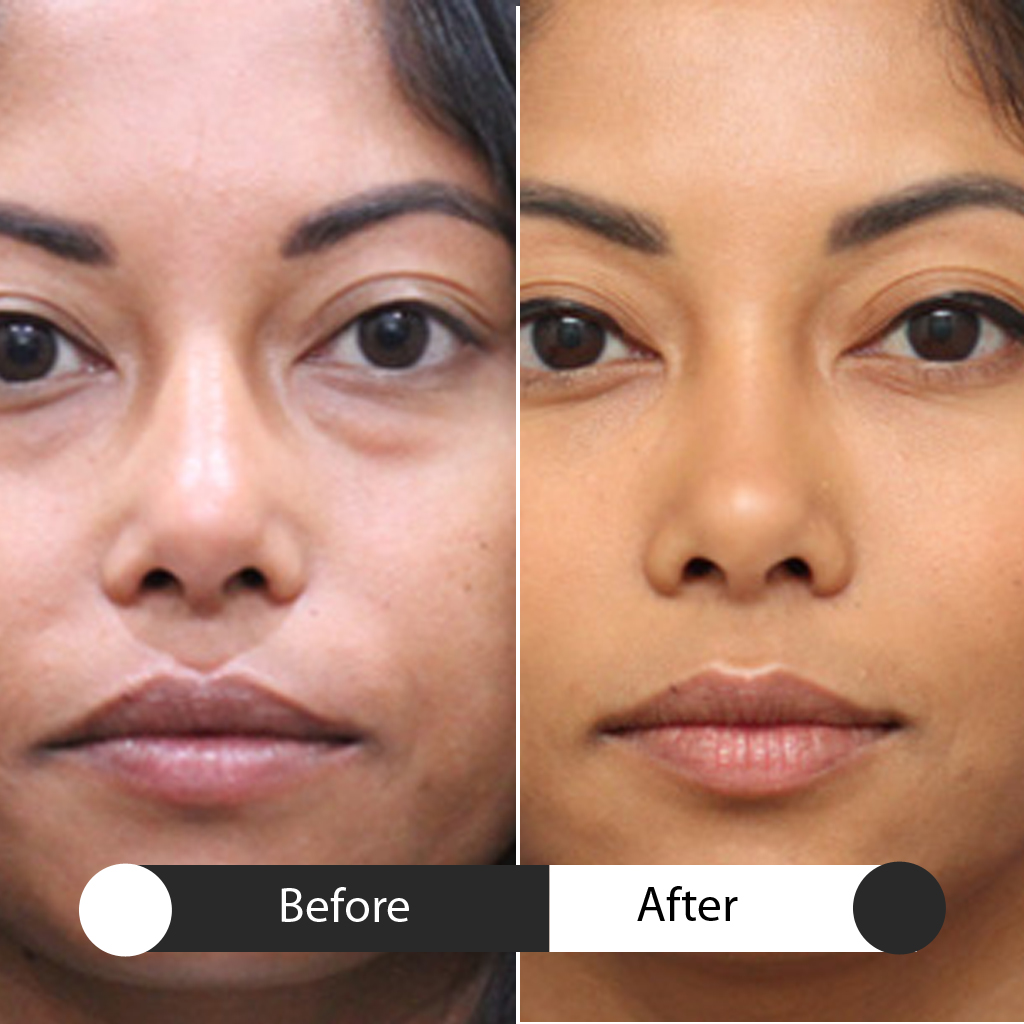 neurotoxins before & after third treatment