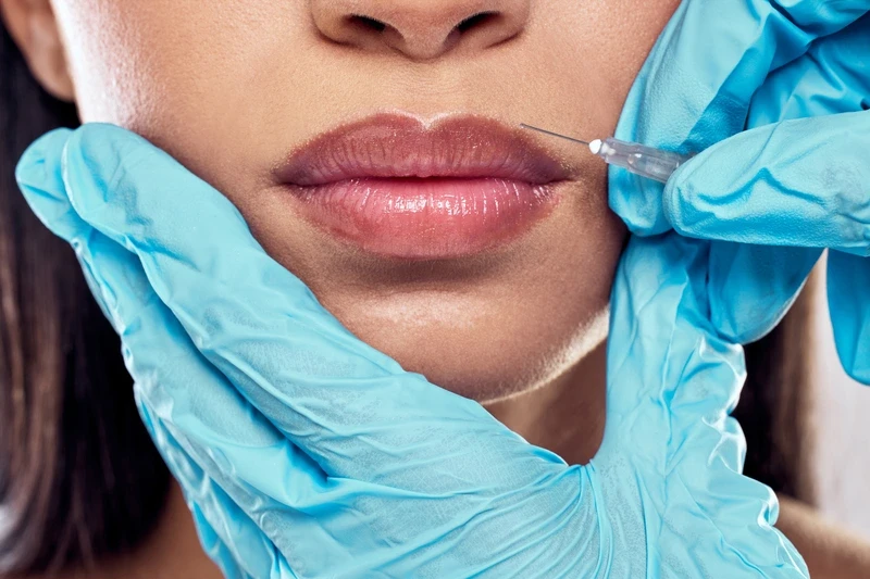 lip fillers cost​