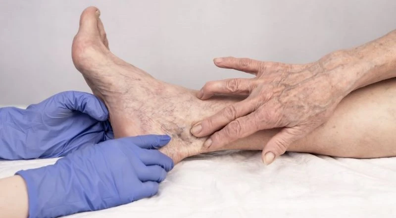 sclerotherapy cost