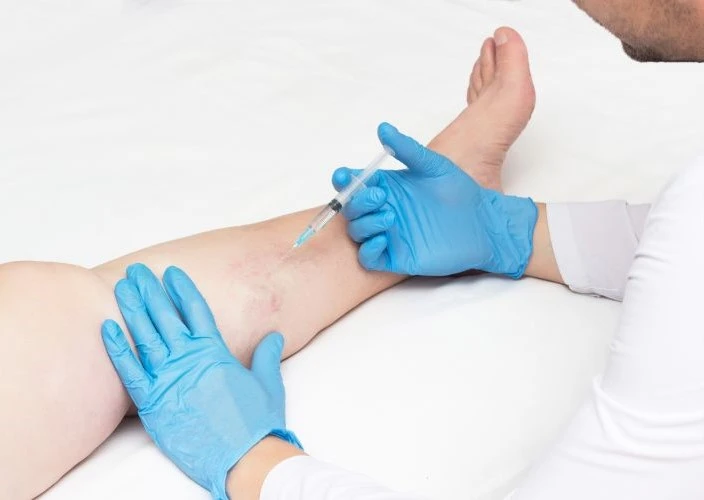 sclerotherapy recovery​