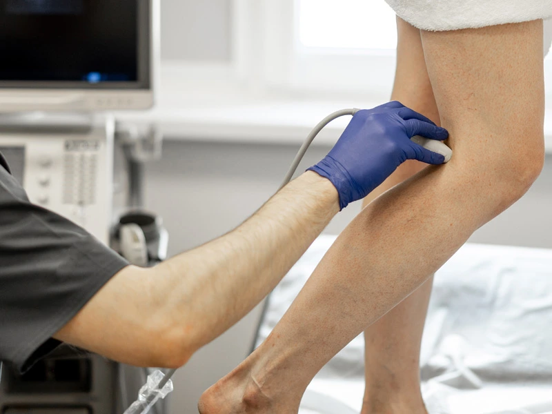 sclerotherapy treatment process