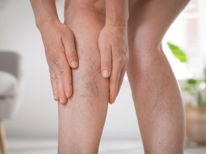 varicose veins benefits