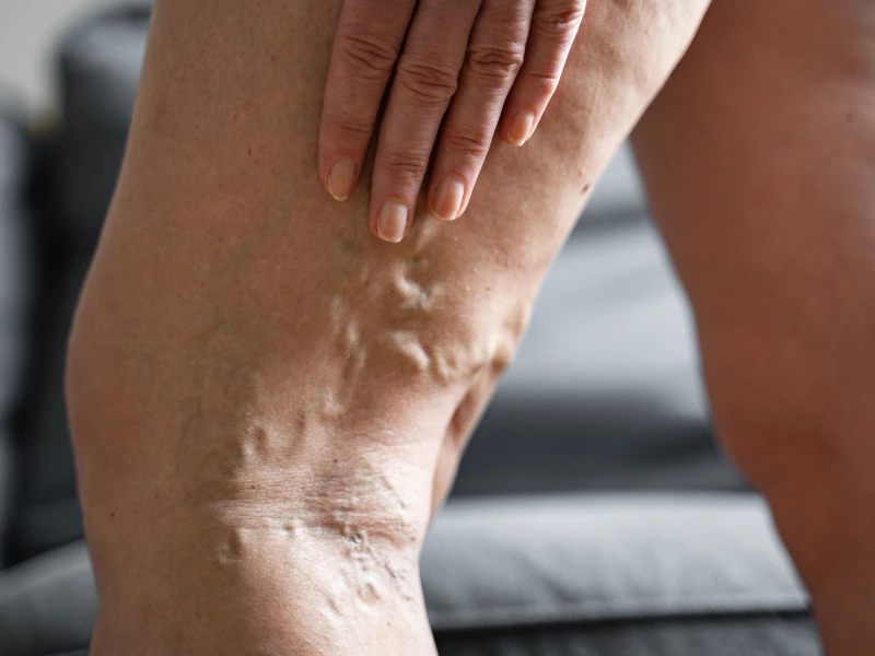 varicose veins treatment candidates