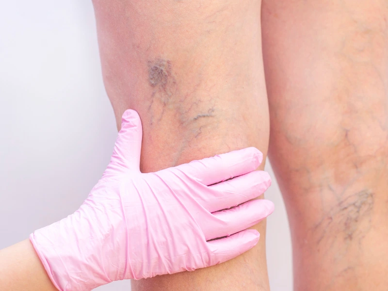 what are varicose veins