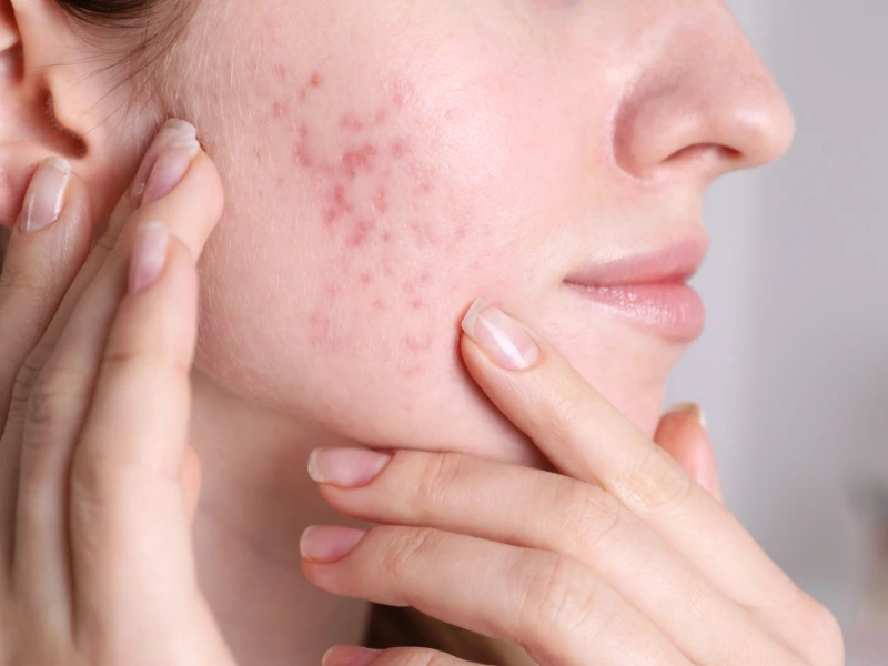 Acne Treatment