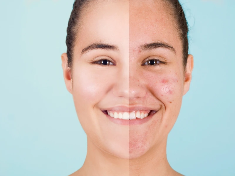acne treatment before and after