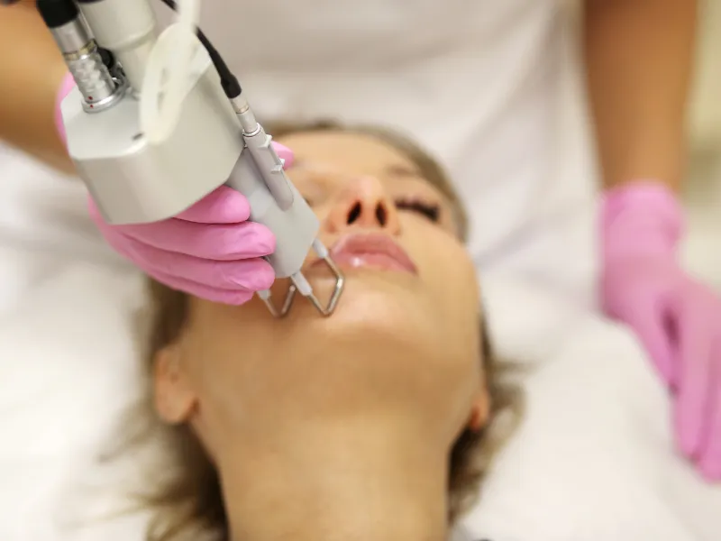 laser hyperpigmentation removal procedure