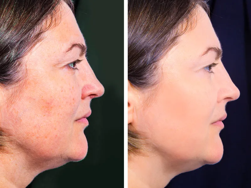 removing hyperpigmentation with laser benefits