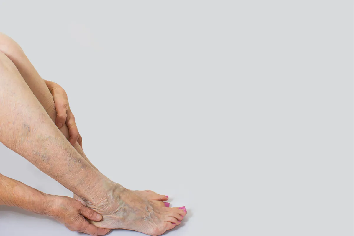 spider veins treatment
