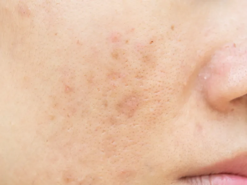 what are sun spots?