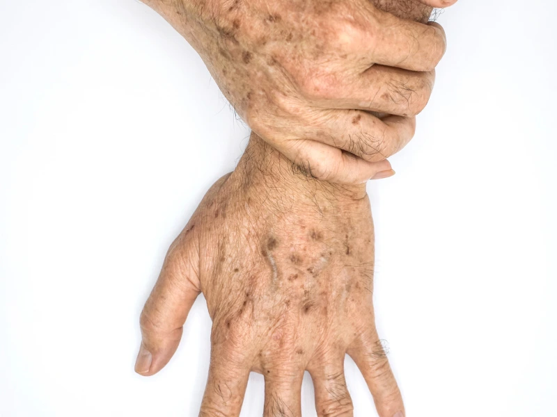 what is age spots treatment?