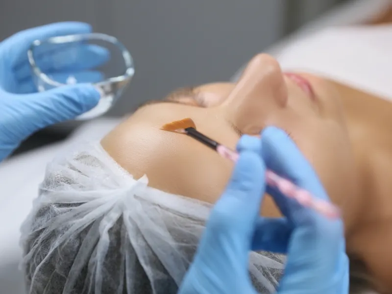 chemical peel for hyperpigmentation