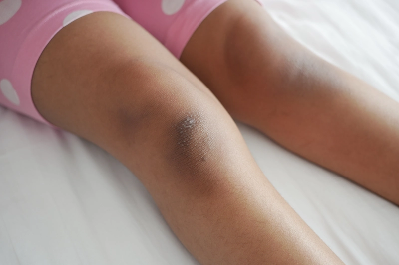 what is knee whitening?