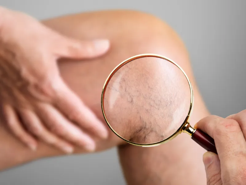 reduce spider veins