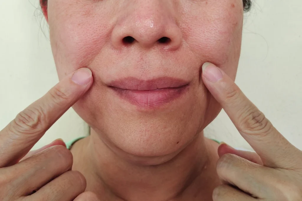 smile lines removal options